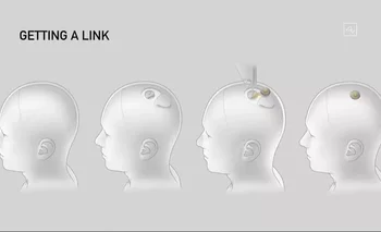 Dibujo de los diferentes pasos de la implantación del dispositivo interfaz de Neuralink en el cerebro.