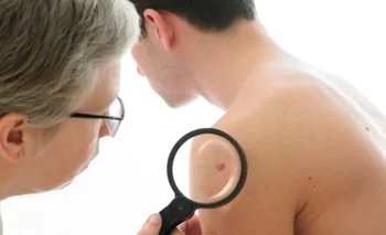 La autoexploración es fundamental para una detección temprana del cáncer de piel.